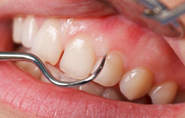 Gros plan sur des dents supérieures maintenues par des outils dentaires pour éliminer la plaque